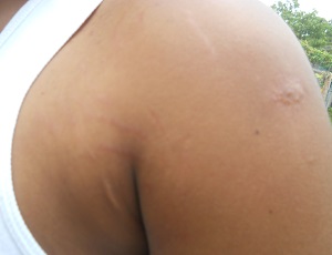 Uno de los estudiantes afectado por la picazón que le provocó el Fogaraté 